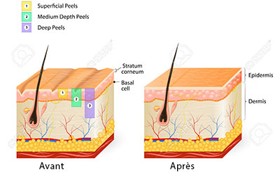 Basics-chemical-peeling-Tunisia